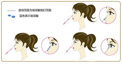 微信整形示意图