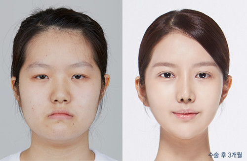 韩国DA整形外科改脸型对比案例