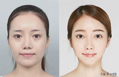 韩国DA整形外科脸型轮廓对比案例