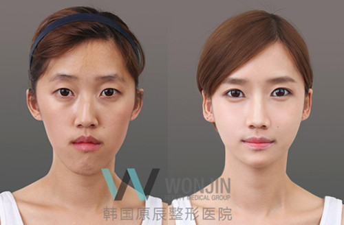 韩国原辰改脸型对比案例