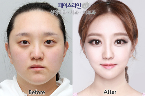 韩国菲斯莱茵改脸型对比案例