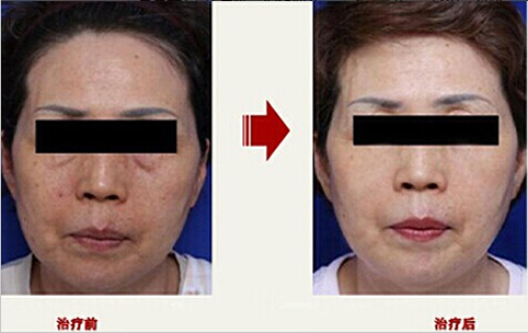 韩国童颜中心面部提升术对比图