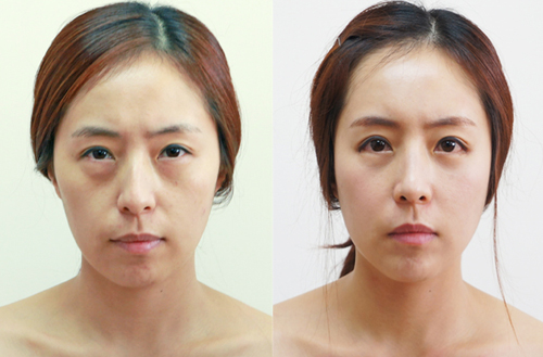 干细胞皮肤再生术对比案例