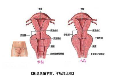 阴道紧缩术前术后对比图