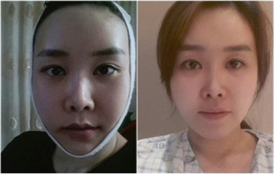 韩国face-line整形外科颧骨整形手术经历