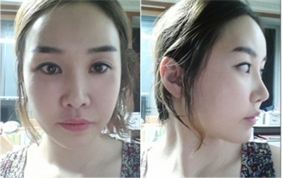 韩国face-line整形外科下颌角整形案例