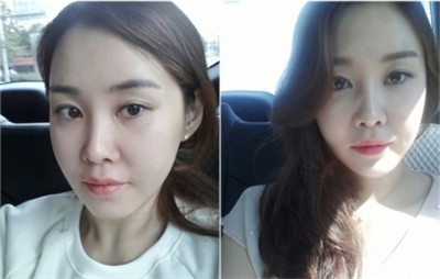 韩国face-line整形外科磨骨手术案例
