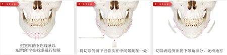 韩国TL整形医院面部轮廓手术示意图