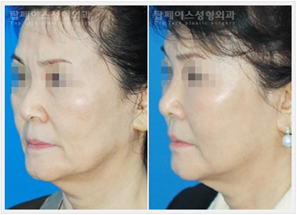 韩国秀美颜整形医院电波拉皮除皱术前后对比图