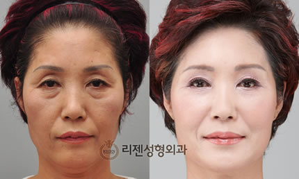 韩国丽珍整形医院微创小切口除皱术前后对比图