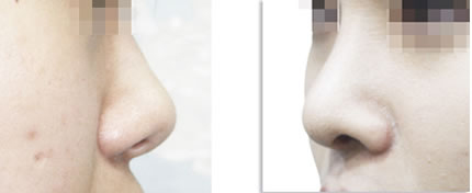 不同类型的鼻部整形手术方法介绍