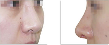 不良假体隆鼻修复对比图