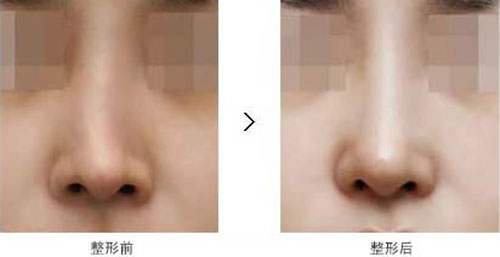 韩国原辰鼻修复前后对比图