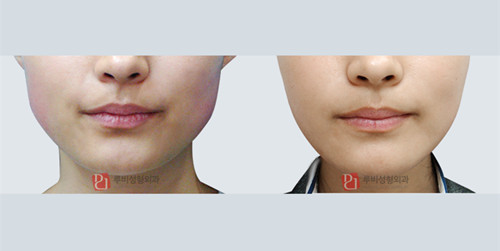 瘦脸针对比案例 韩国ruby整形外科对比案例