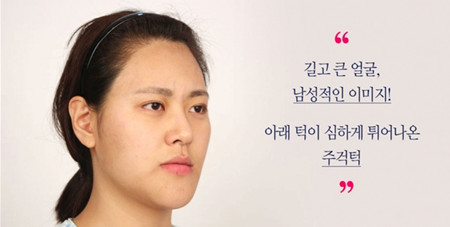 韩国faceline整形外科轮廓手术对比日记