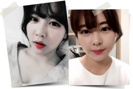 韩国faceline整形外科下颌角整容日记术后两个月