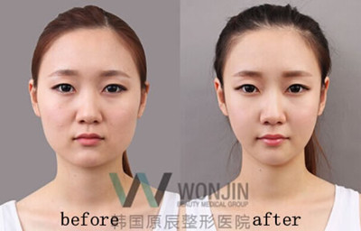 韩国原辰面部轮廓手术对比