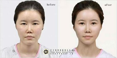 韩国灰姑娘整形外科对比