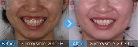 韩国江南美丽微笑牙科 牙齿矫正对比案例