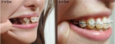 韩国牙齿矫正术后第五个月与第八个月对比图