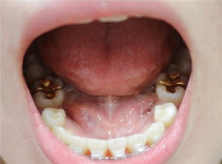 韩国牙齿矫正过程