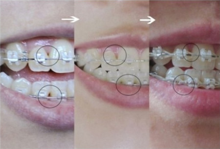 韩国牙齿矫正中各阶段变化