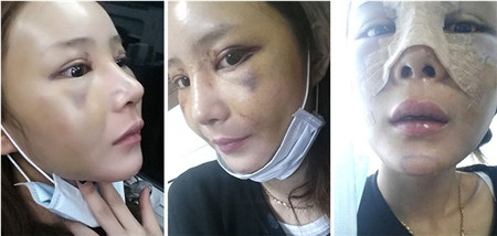韩国ID隆鼻手术恢复日记术后一周