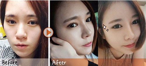 韩国秀美颜整形外科隆鼻手术经历