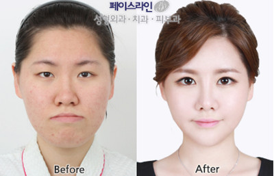 韩国face-line整形医院 双鄂手术对比图
