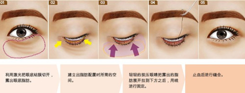 韩国眼底脂肪重新排列手术去黑眼圈会反弹吗？