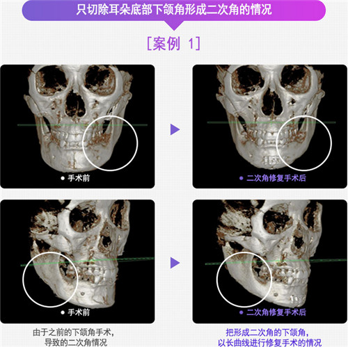 韩国DA整形外科面部轮廓修复