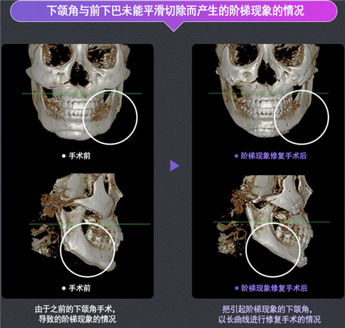 韩国DA下颌角手术修复