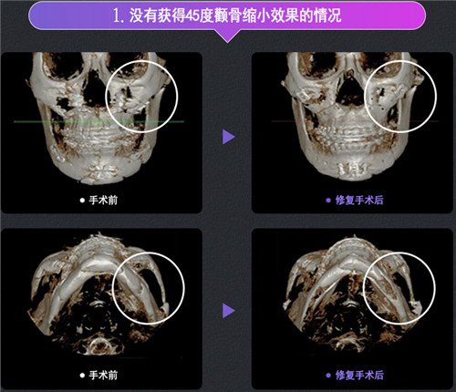 韩国DA整形外科下颌角手术