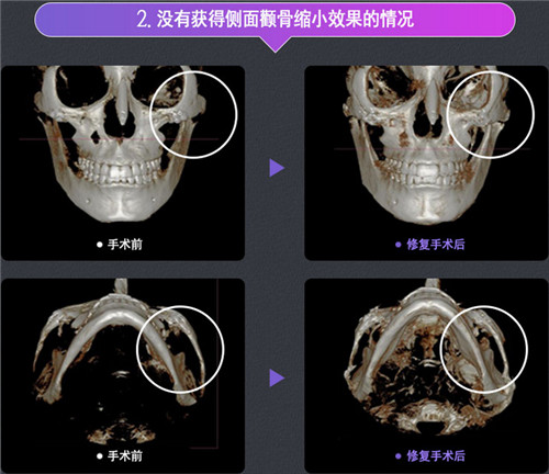 韩国DA整形外科下颌角手术修复对比