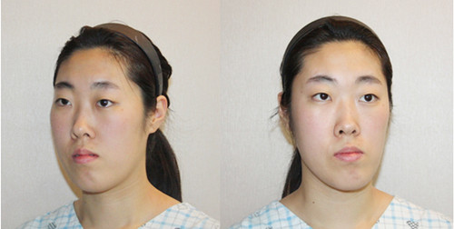 韩国face-line整形外科轮廓手术经历