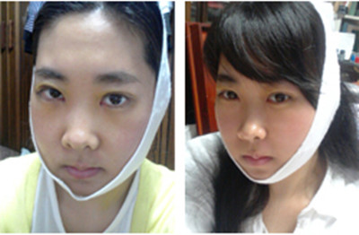 韩国菲斯莱茵面部轮廓手术真实经历