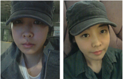 韩国面部轮廓手术案例术后一个月