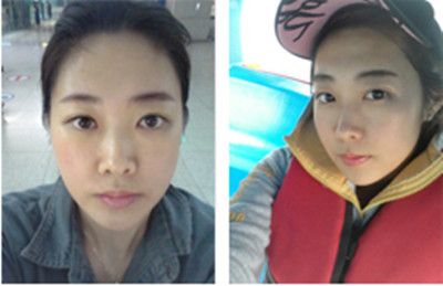 韩国面部轮廓手术案例恢复日记