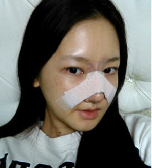 韩国巴诺巴奇隆鼻术后一周恢复