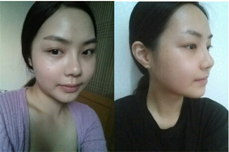韩国巴诺巴奇脸型轮廓手术术后六个月