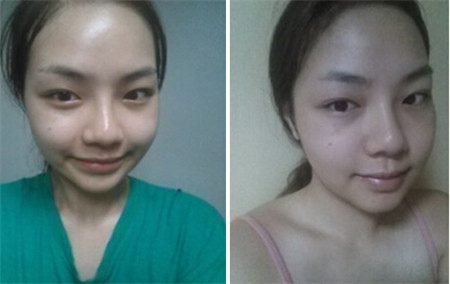 韩国巴诺巴奇下颌角整形术后7个月恢复