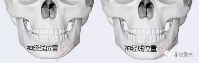 下颌角手术时避开神经线