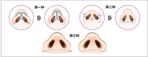 鼻翼缩小手术方法示意图