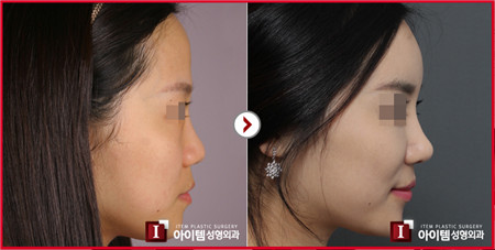 韩国爱婷隆鼻手术前后对比