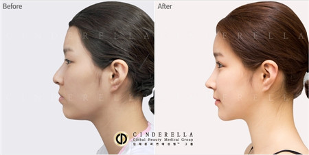 韩国新帝瑞娜整形外科隆鼻对比图
