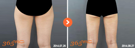 韩国365MC大腿吸脂对比