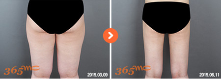 韩国365MC大腿吸脂对比