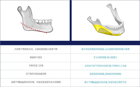 下颌角整形手术与传统手术的对比