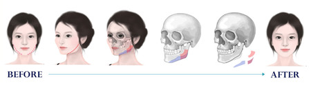韩国faceline整形外科下颌角手术