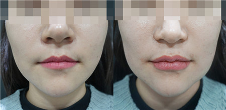 韩国首尔激光溶脂瘦脸效果靠谱的医院
